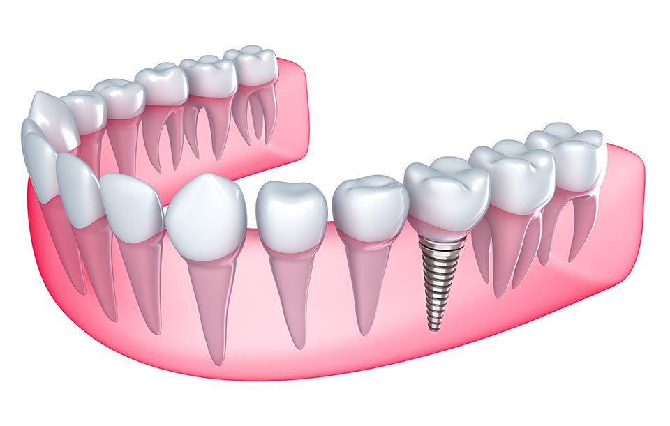 Implant Dentistry High River | Highwood Dental | General and Family Dentist in High River, AB