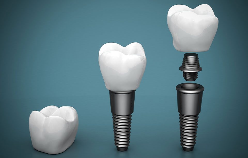 Dental Implant Restoration | Highwood Dental | General and Family Dentist | High River, AB