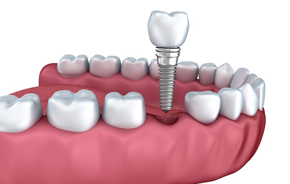 Dental Implant Surgery | Highwood Dental | General and Family Dentist | High River, AB