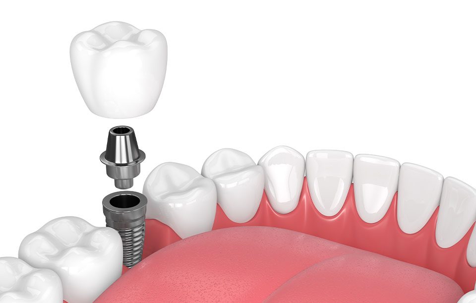 What are dental implants | Highwood Dental | General and Family Dentist | High River, AB