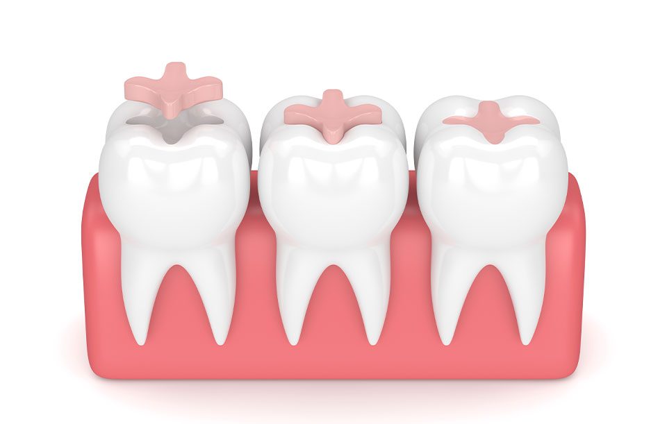 What are dental inlays and onlays | Highwood Dental | General and Family Dentist | High River, AB