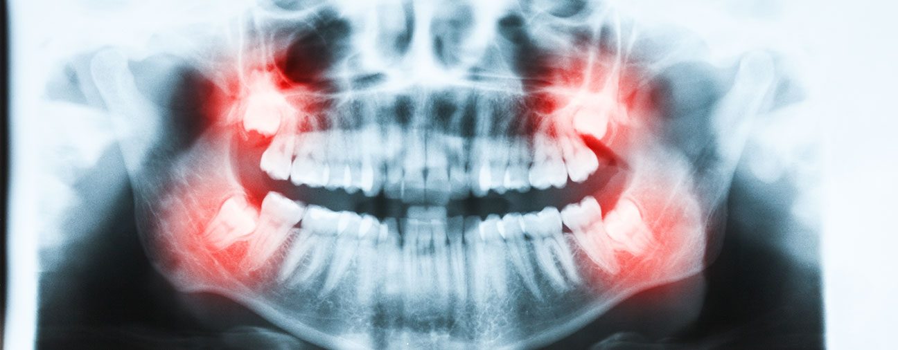 What are wisdom teeth extraction | Highwood Dental | High River, AB