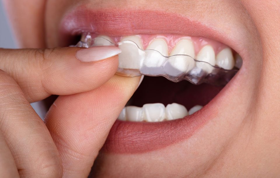 What Conditions Can Invisalign Treat | Highwood Dental | General and Family Dentist