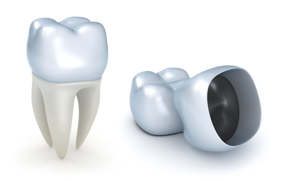 What is a dental crown | Highwood Dental | Family Dentistry | High River, AB