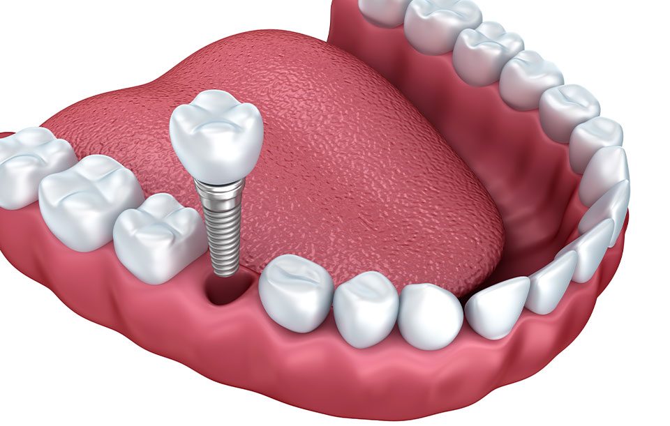 What is Implant Dentistry | Highwood Dental | General and Family Dentist | High River, AB