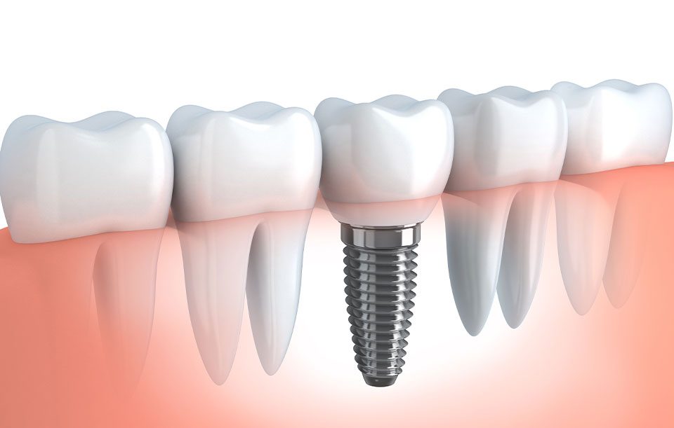 Dental Implant Dentistry | Highwood Dental | General and Family Dentist | High River, AB