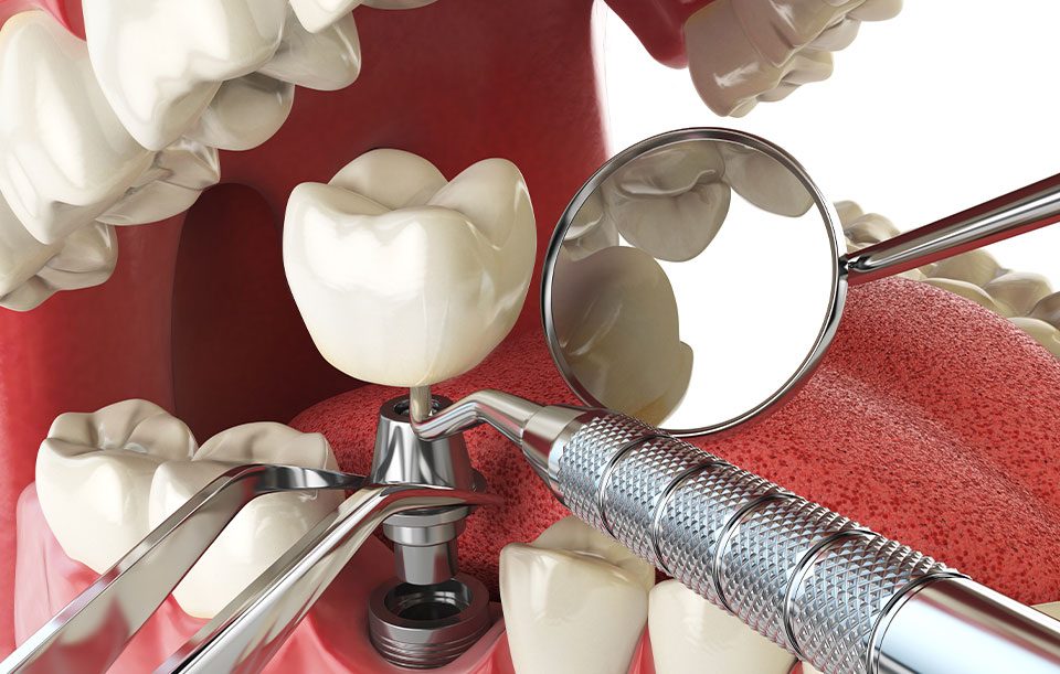 What is implant restoration | Highwood Dental | General and Family Dentist | High River, AB