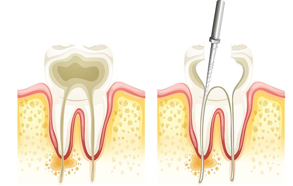 What is Root Canal Therapy | Highwood Dental | General and Family Dentist | High River, AB