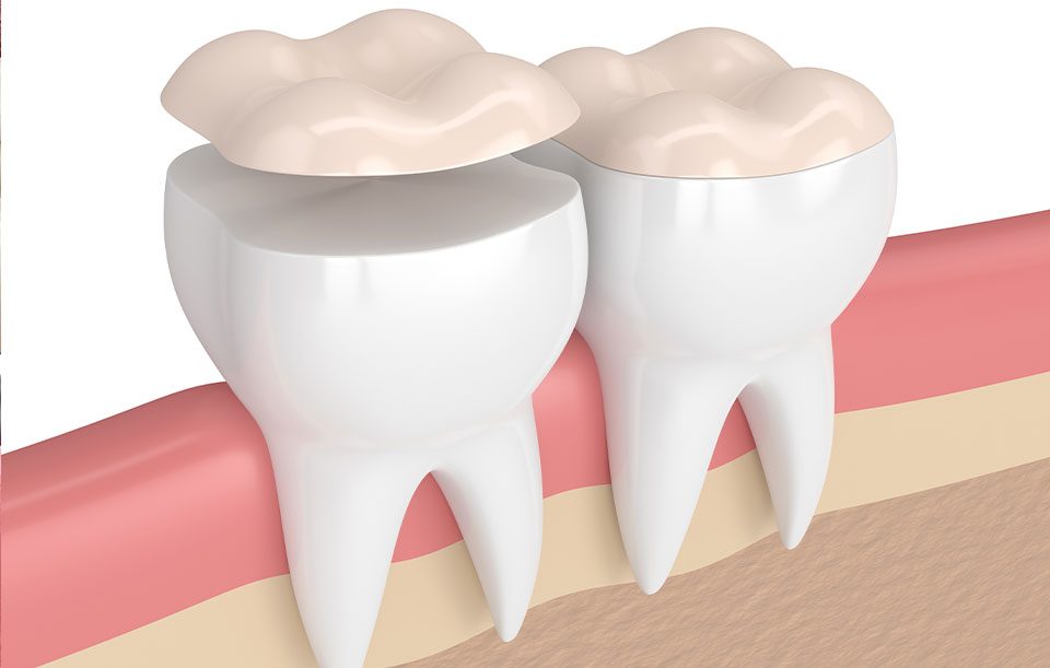 When are dental inlays and onlays | Highwood Dental | General and Family Dentist | High River, AB